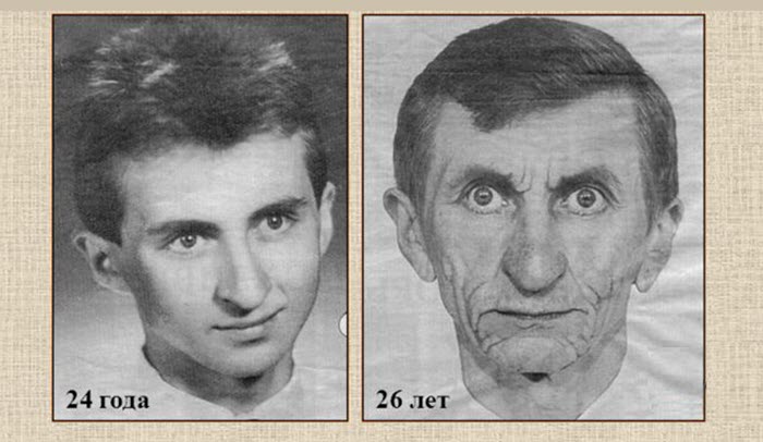 Синдром Вернера