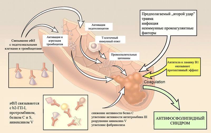 Антифосфолипидный синдром