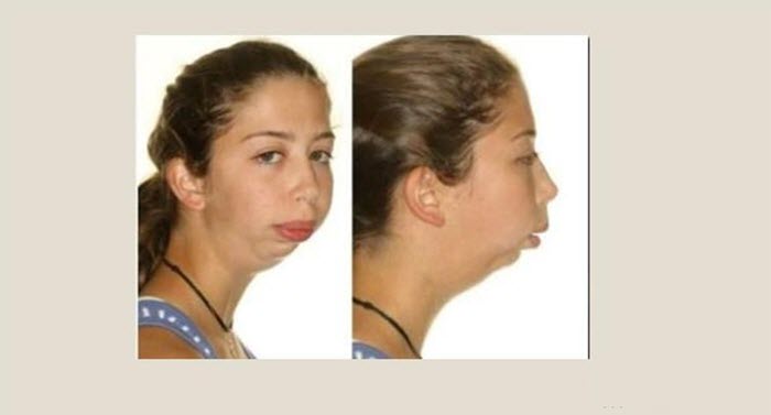 Микрогнатия