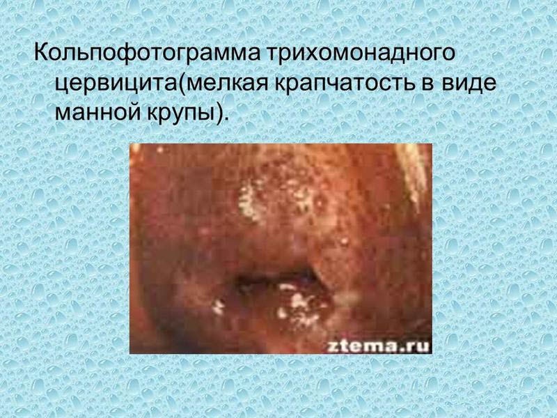 Синдром манной крупы