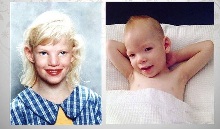 Особенности больных с синдромом кошачьего крика