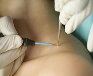 дерматофиброма фото после удаления