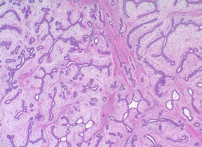 Интраканаликулярная фиброаденома Интраканаликулярная фиброаденома