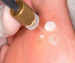 шипица на ноге лечение фото