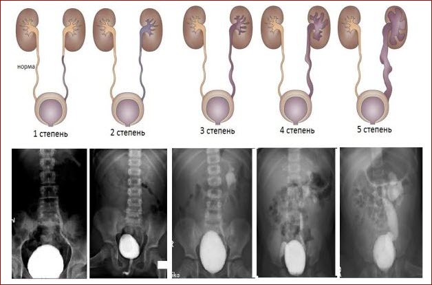 Стадии заболевания почек