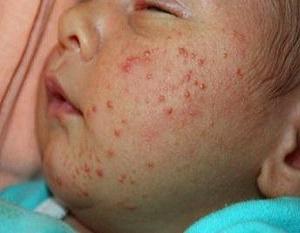 как выглядит диатез у детей фото