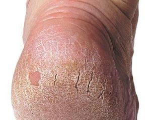 трещины на пятках фото