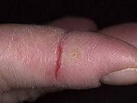 трещины на пальцах рук