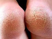 трещины на пятках лечение народными средствами