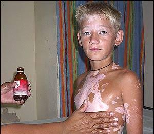 витилиго фото