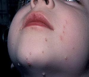 контагиозный моллюск у детей лечение фото