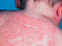 у ребенка крапивница что делать