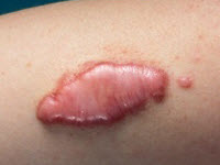 удаление коллоидных рубцов