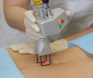 коллоидные рубцы удаление фото