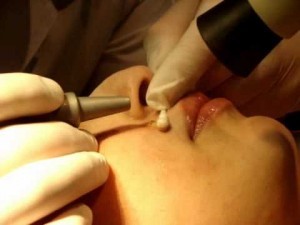 удаление родинок лазером фото