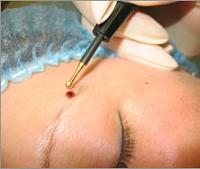 удаление родинок на лице