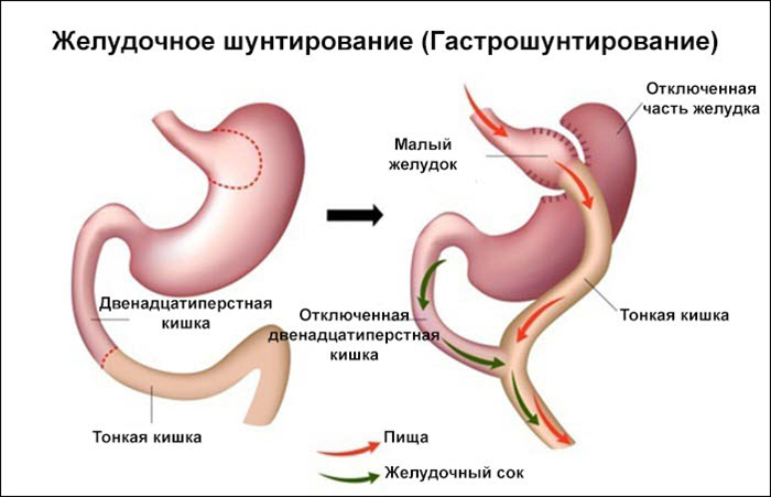 Гастрошунтирование