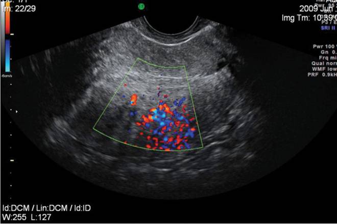 Цветное доплеровское картирование Цветное доплеровское картирование