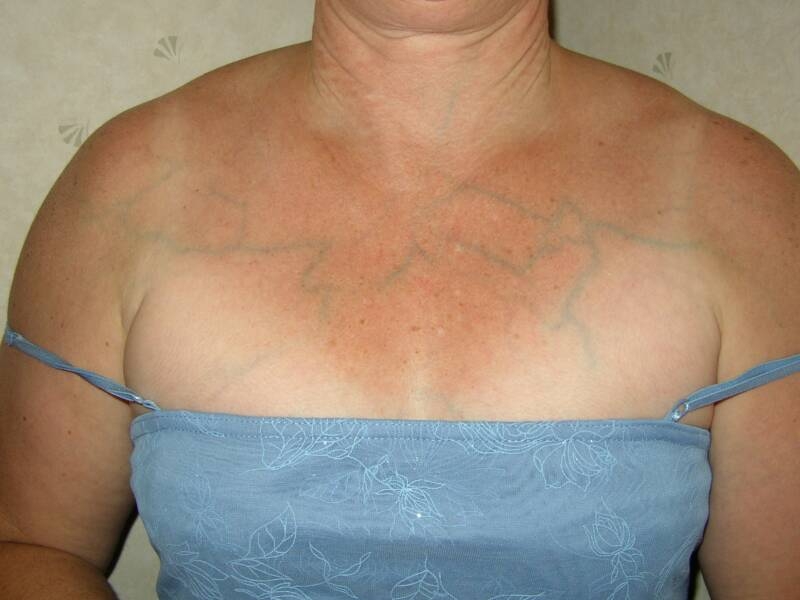 Вены на груди