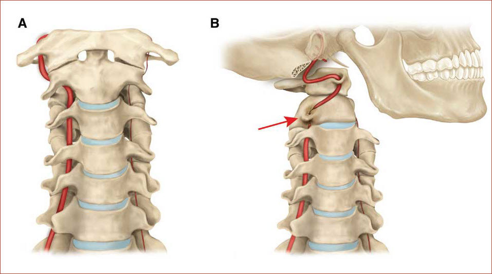 Защемление позвоночной артерии