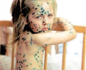 первые симптомы ветрянки у детей фото