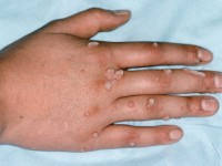 вирус папилломы человека