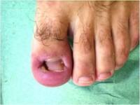 вросший ноготь на большом пальце ноги лечение