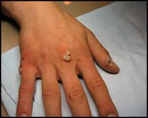 бородавки на руках фото