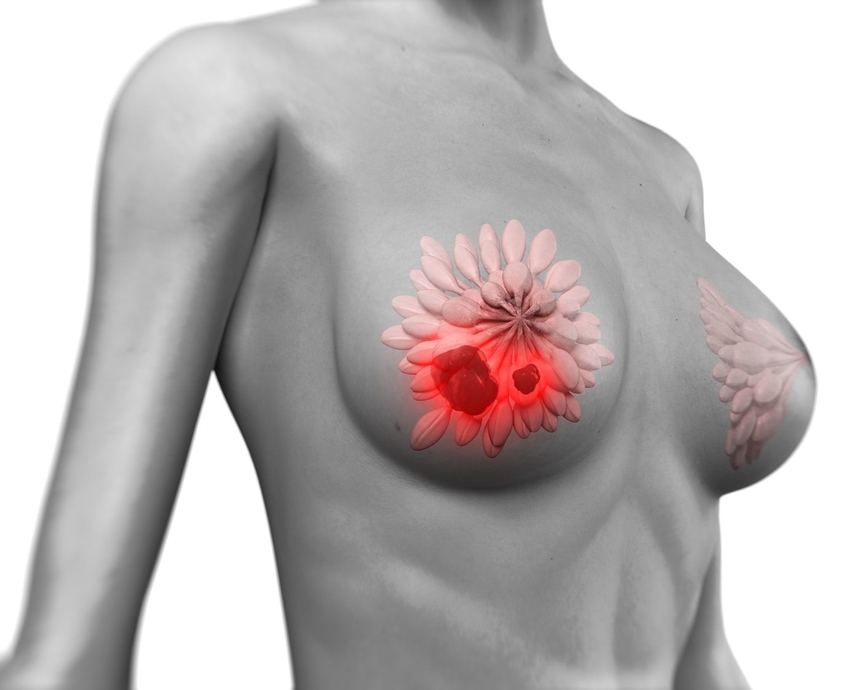 Рак груди 3D Рак груди 3D