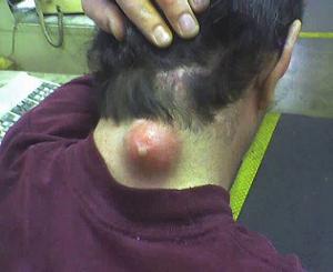 фурункул признаки фото