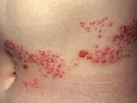 заразен ли опоясывающий герпес