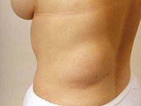 лечение жировика на теле